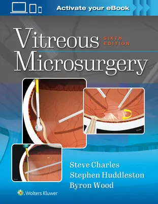 Microcirugía vítrea - Vitreous Microsurgery