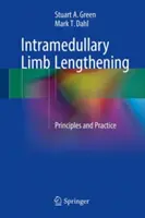 Alargamiento intramedular de extremidades: Principios y práctica - Intramedullary Limb Lengthening: Principles and Practice