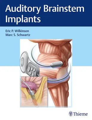 Implantes auditivos de tronco cerebral - Auditory Brainstem Implants