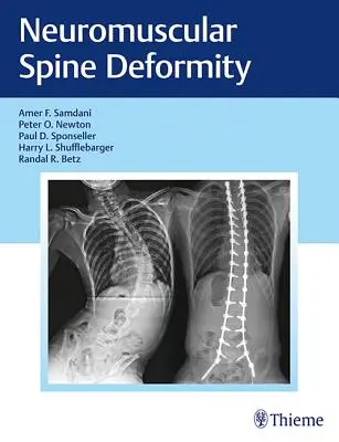 Deformidad Neuromuscular de la Columna Vertebral - Neuromuscular Spine Deformity