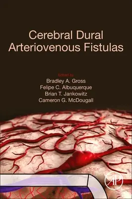 Fístulas arteriovenosas durales cerebrales - Cerebral Dural Arteriovenous Fistulas