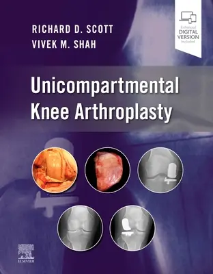 Artroplastia unicompartimental de rodilla - Unicompartmental Knee Arthroplasty