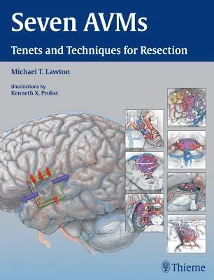 Siete Avms: Principios y técnicas de resección - Seven Avms: Tenets and Techniques for Resection