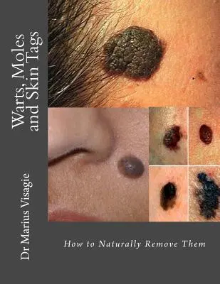 Verrugas, lunares y marcas en la piel: Cómo eliminarlas de forma natural - Warts, Moles and Skin Tags: How to Naturally Remove Them