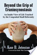 Más allá de la craneosinostosis: Una visión desde dentro de la vida afectada por esta deformidad congénita del cráneo. - Beyond the Grip of Craniosynostosis: An Inside View of Life Touched by the Congenital Skull Deformity