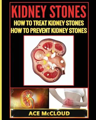 Cálculos renales: Cómo tratar los cálculos renales: Cómo prevenir los cálculos renales - Kidney Stones: How To Treat Kidney Stones: How To Prevent Kidney Stones