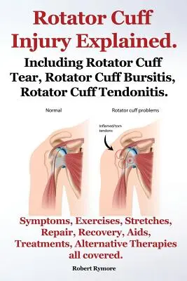 Explicación de las lesiones del manguito de los rotadores. Incluyendo Desgarro del Manguito Rotador, Bursitis del Manguito Rotador, Tendinitis del Manguito Rotador. Síntomas, ejercicios, estiramientos, reparación y tratamiento. - Rotator Cuff Injury Explained. Including Rotator Cuff Tear, Rotator Cuff Bursitis, Rotator Cuff Tendonitis. Symptoms, Exercises, Stretches, Repair, Re