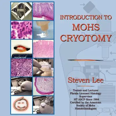 Introducción a la criotomía MOHS - Introduction to MOHS Cryotomy