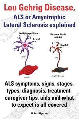 La Enfermedad de Lou Gehrig, ELA o Esclerosis Lateral Amiotrófica Explicada. Síntomas de la ELA, Signos, Etapas, Tipos, Diagnóstico, Tratamiento, Consejos para el cuidador, SIDA y - Lou Gehrig Disease, ALS or Amyotrophic Lateral Sclerosis Explained. ALS Symptoms, Signs, Stages, Types, Diagnosis, Treatment, Caregiver Tips, AIDS and