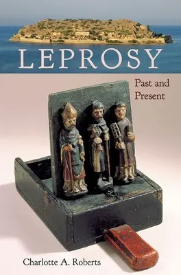 Lepra: pasado y presente - Leprosy: Past and Present