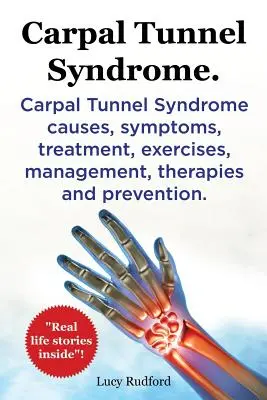 Síndrome Del Túnel Carpiano, Cts. Síndrome del Túnel Carpiano Cts Causas, Síntomas, Tratamiento, Ejercicios, Manejo, Terapias y Prevención. - Carpal Tunnel Syndrome, Cts. Carpal Tunnel Syndrome Cts Causes, Symptoms, Treatment, Exercises, Management, Therapies and Prevention.
