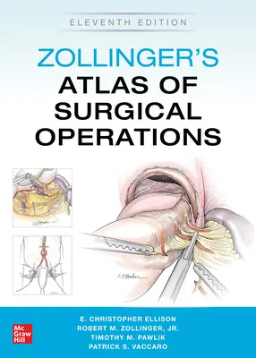 Atlas de operaciones quirúrgicas de Zollinger, undécima edición - Zollinger's Atlas of Surgical Operations, Eleventh Edition