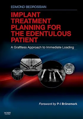 Planificación del tratamiento con implantes para el paciente edéntulo: Un enfoque sin injertos para la carga inmediata - Implant Treatment Planning for the Edentulous Patient: A Graftless Approach to Immediate Loading