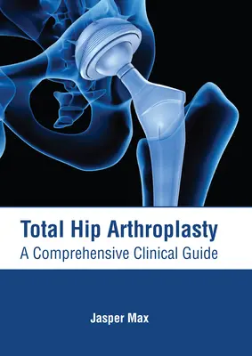 Artroplastia total de cadera: A Comprehensive Clinical Guide - Total Hip Arthroplasty: A Comprehensive Clinical Guide
