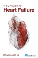 Las 4 fases de la insuficiencia cardíaca - The 4 Stages of Heart Failure