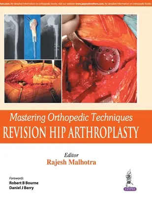 Dominio de las Técnicas Ortopédicas: Artroplastia Total de Cadera de Revisión - Mastering Orthopedic Techniques: Revision Total Hip Arthroplasty