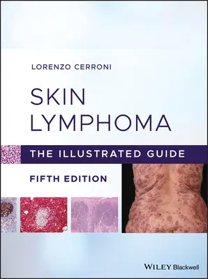 Linfoma cutáneo: La guía ilustrada - Skin Lymphoma: The Illustrated Guide