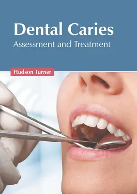 Caries dental: Evaluación y tratamiento - Dental Caries: Assessment and Treatment