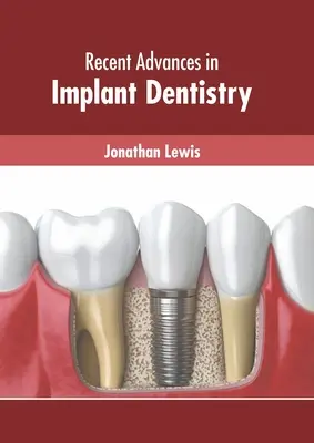 Avances recientes en implantología - Recent Advances in Implant Dentistry