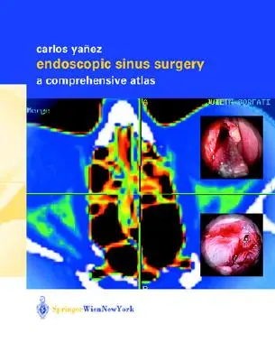 Cirugía endoscópica de los senos paranasales: A Comprehensive Atlas - Endoscopic Sinus Surgery: A Comprehensive Atlas