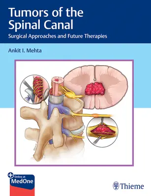 Tumores del canal raquídeo: Abordajes quirúrgicos y terapias futuras - Tumors of the Spinal Canal: Surgical Approaches and Future Therapies