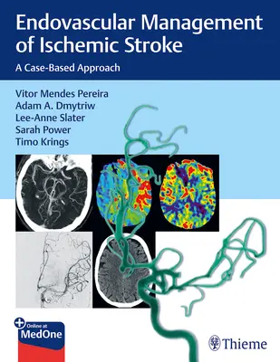 Endovascular Management of Ischemic Stroke: A Case-Based Approach