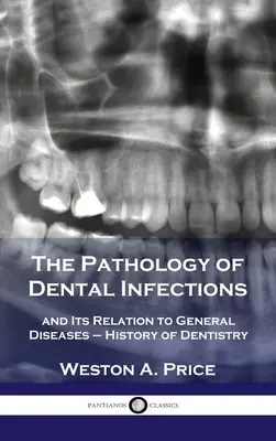 La patología de las infecciones dentales y su relación con las enfermedades generales - Historia de la Odontología - Pathology of Dental Infections: and Its Relation to General Diseases - History of Dentistry