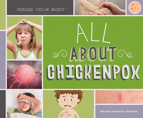 Todo sobre la varicela - All about Chickenpox