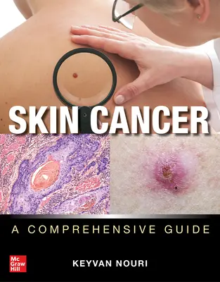 Cáncer de piel: Una guía completa - Skin Cancer: A Comprehensive Guide
