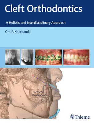 Ortodoncia de fisuras: Un enfoque holístico e interdisciplinario - Cleft Orthodontics: A Holistic and Interdisciplinary Approach