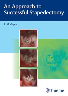 Un enfoque para el éxito de la estapedectomía - An Approach to Successful Stapedectomy