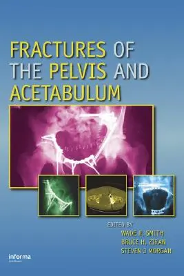 Fracturas de pelvis y acetábulo - Fractures of the Pelvis and Acetabulum