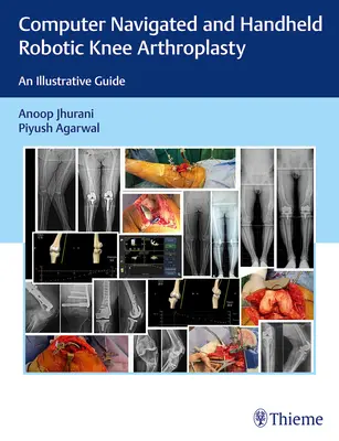 Computer Navigated and Handheld Robotic Knee Arthroplasty: Una guía ilustrativa - Computer Navigated and Handheld Robotic Knee Arthroplasty: An Illustrative Guide