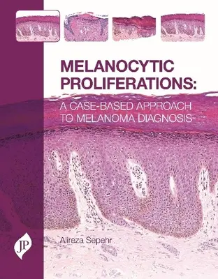 Proliferaciones Melanocíticas - Un Enfoque Basado en Casos para el Diagnóstico del Melanoma - Melanocytic Proliferations - A Case-Based Approach to Melanoma Diagnosis