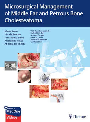 Tratamiento microquirúrgico del colesteatoma del oído medio y del hueso petroso - Microsurgical Management of Middle Ear and Petrous Bone Cholesteatoma