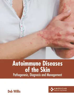 Enfermedades Autoinmunes de la Piel: Patogénesis, Diagnóstico y Manejo - Autoimmune Diseases of the Skin: Pathogenesis, Diagnosis and Management