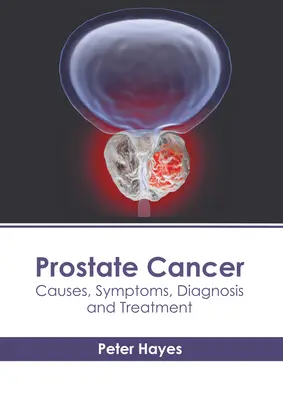 Cáncer de próstata: Causas, síntomas, diagnóstico y tratamiento - Prostate Cancer: Causes, Symptoms, Diagnosis and Treatment