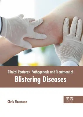 Características clínicas, patogenia y tratamiento de las enfermedades ampollosas - Clinical Features, Pathogenesis and Treatment of Blistering Diseases