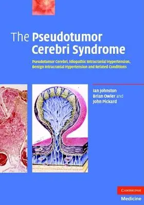 El Síndrome de Pseudotumor Cerebri - The Pseudotumor Cerebri Syndrome