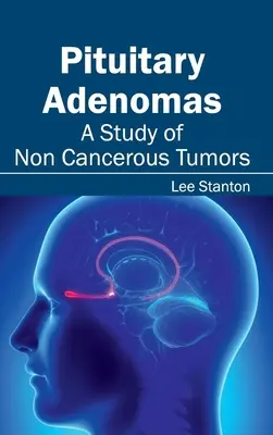 Adenomas hipofisarios: Un estudio de los tumores no cancerosos - Pituitary Adenomas: A Study of Non Cancerous Tumors