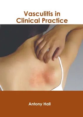 Vasculitis en la práctica clínica - Vasculitis in Clinical Practice