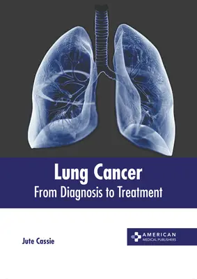 Cáncer de pulmón: Del diagnóstico al tratamiento - Lung Cancer: From Diagnosis to Treatment