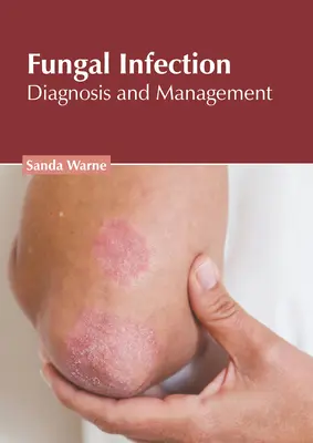 Infección fúngica: Diagnóstico y tratamiento - Fungal Infection: Diagnosis and Management
