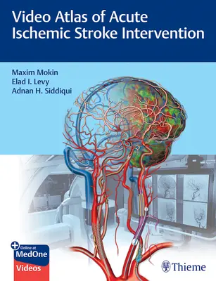 Videoatlas de la intervención en el ictus isquémico agudo - Video Atlas of Acute Ischemic Stroke Intervention