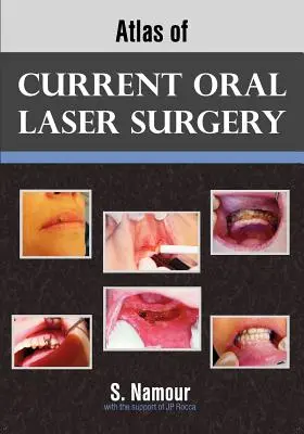 Atlas de la cirugía láser oral actual - Atlas of Current Oral Laser Surgery