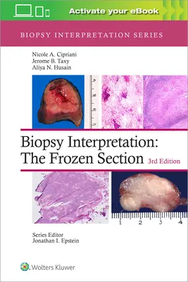 Interpretación de la biopsia: La sección congelada - Biopsy Interpretation: The Frozen Section