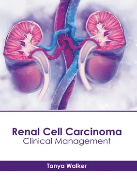 Carcinoma de células renales: tratamiento clínico - Renal Cell Carcinoma: Clinical Management