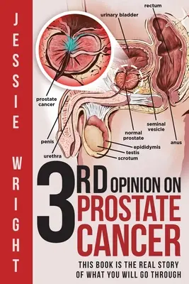 La tercera opinión sobre el cáncer de próstata - 3rd Opinion on Prostate Cancer