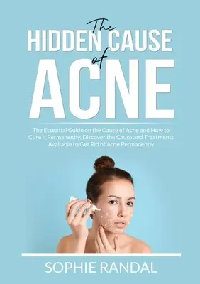La Causa Oculta del Acné: La Guía Esencial sobre la Causa del Acné y Cómo Curarlo Permanentemente, Descubre la Causa y los Tratamientos Disponibles t - The Hidden Cause of Acne: The Essential Guide on the Cause of Acne and How to Cure it Permanently, Discover the Cause and Treatments Available t