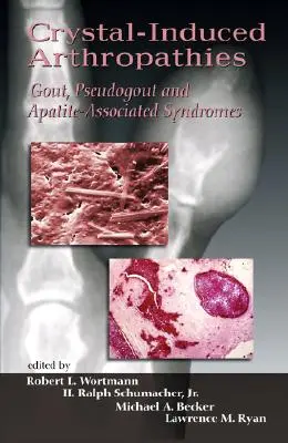 Artropatías inducidas por cristales: Gota, seudogota y síndromes asociados a la apatita - Crystal-Induced Arthropathies: Gout, Pseudogout and Apatite-Associated Syndromes